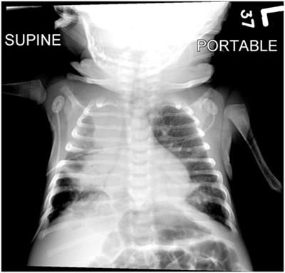 Intrapulmonary Percussive Ventilation as an Airway Clearance Technique during Venoarterial Extracorporeal Life Support in an Infant with Pertussis